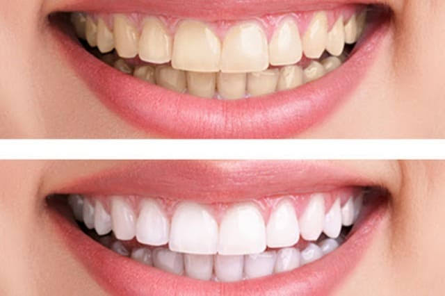 تبييض الأسنان..تعرف على الأساليب المختلفة لتفتيح لونها